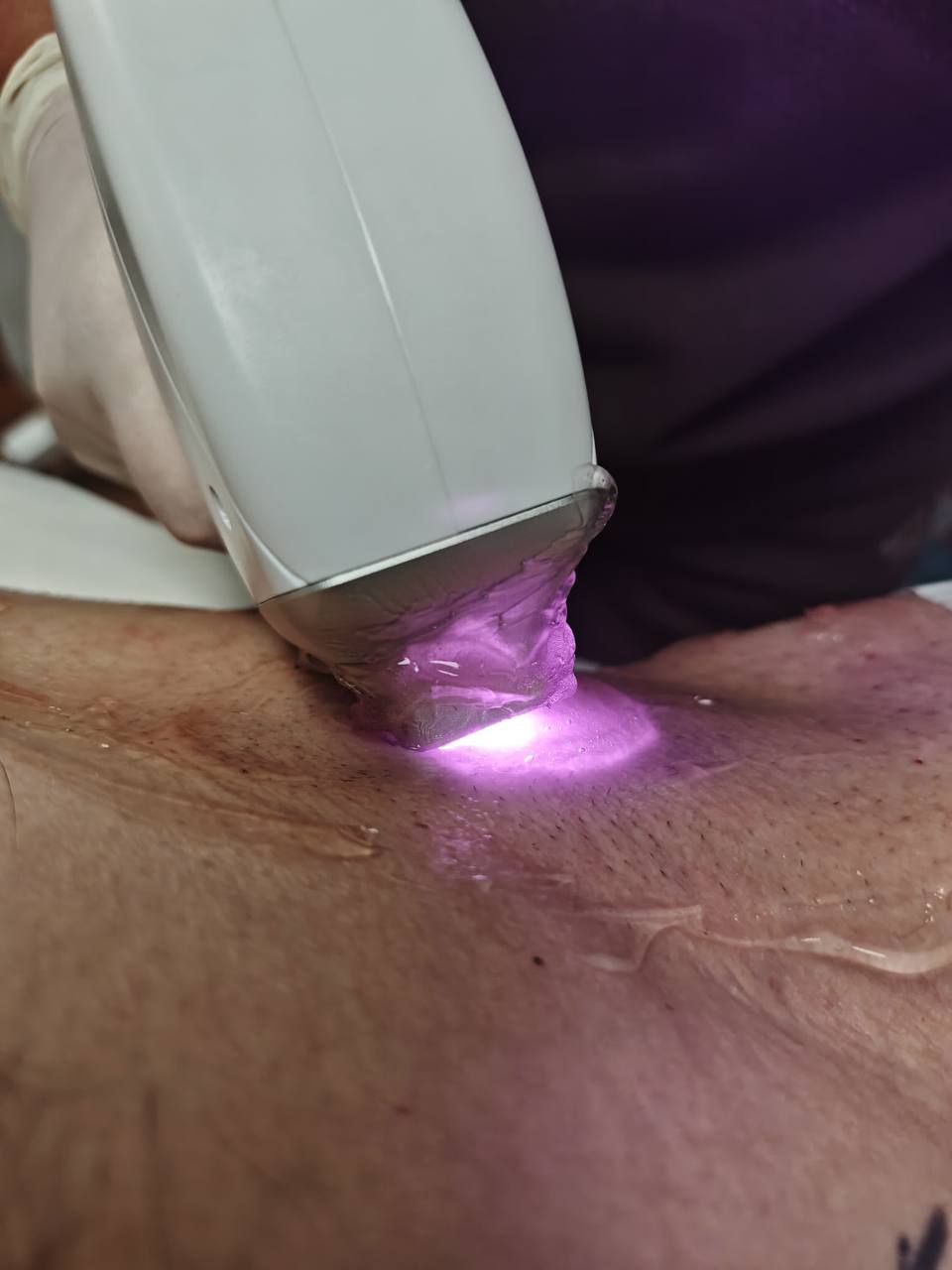 Лазерная система Candela